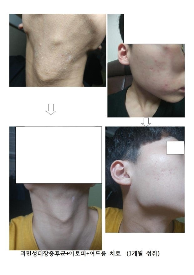 피지낭종 표피낭종 : 지식iN 피지낭종 표피낭종 : 지식In