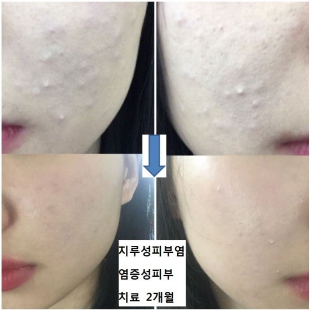 입주위 피부손상 : 지식In