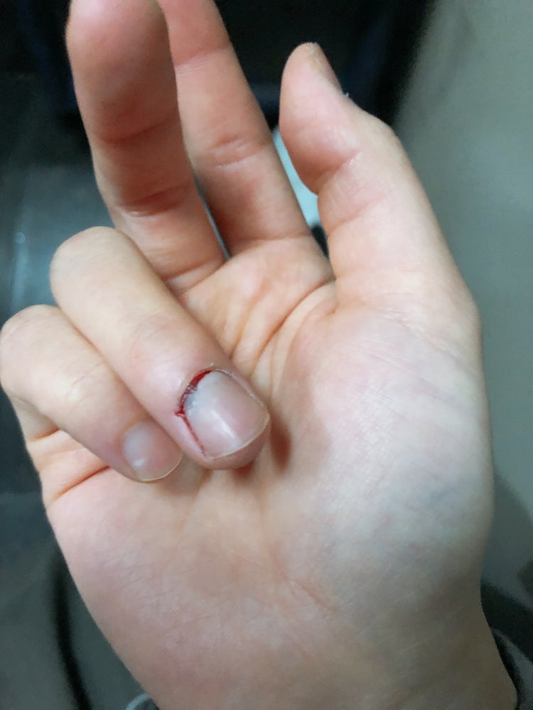 무거운 문에 손가락이 찡겨서 손톱밑쪽에 피가났어요 어디가 긁히거나 한건 아닌데 손톱안쪽에서 피가 난 것 같구요 안에도 약간 고여 ...