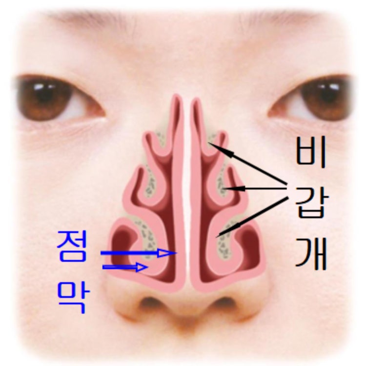 코수술(비밸브,자가늑연골,L지지대 재건) 2개월째 코막힘 ㅠㅠ : 지식iN