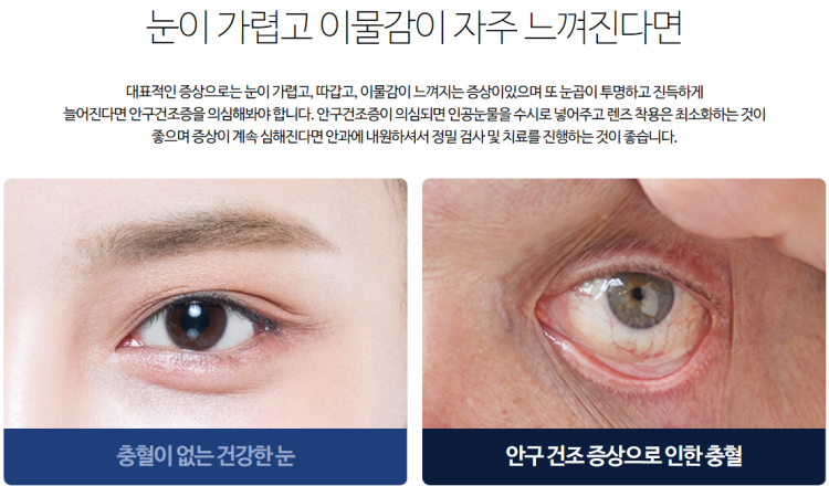 안구건조증 증상 눈이 건조하고 눈꼽이끼는데 맞나요 : 지식iN 안구건조증 증상 눈이 건조하고 눈꼽이끼는데 맞나요 : 지식In