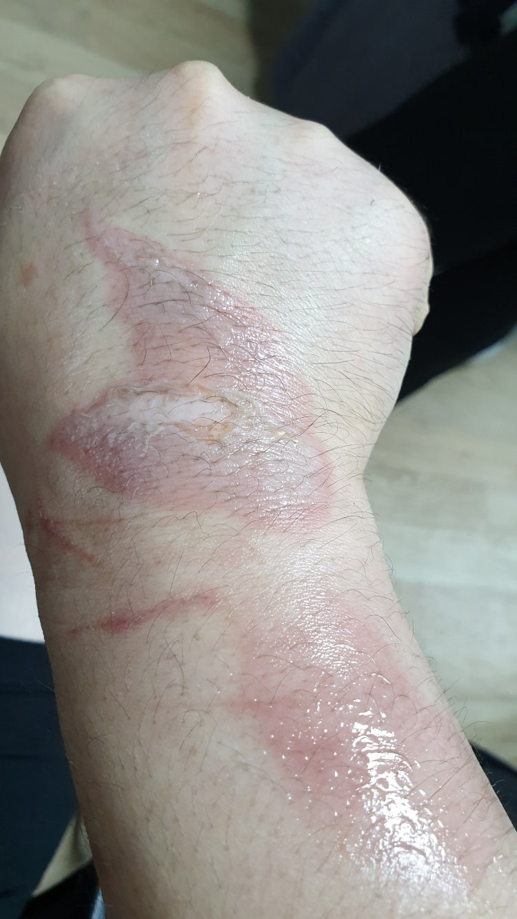 화상 상처 좀 봐주세요 : 지식iN