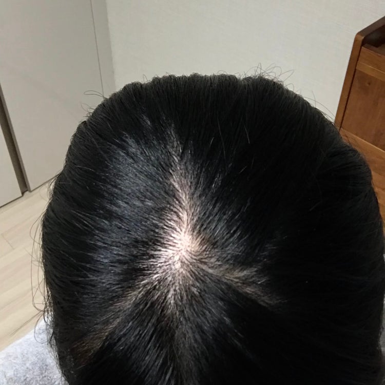 여자 정수리 탈모 초기? : 지식iN 여자 정수리 탈모 초기? : 지식In