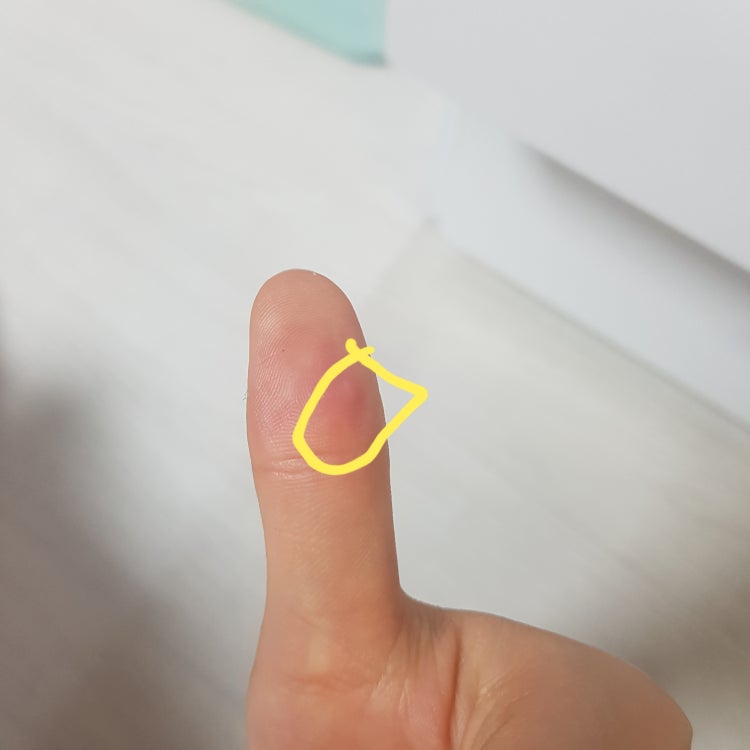 엄지손가락 피부 통증 : 지식In