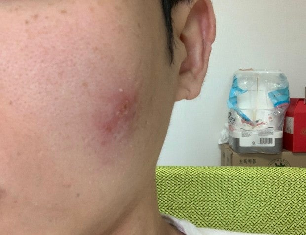 자전거 피부염