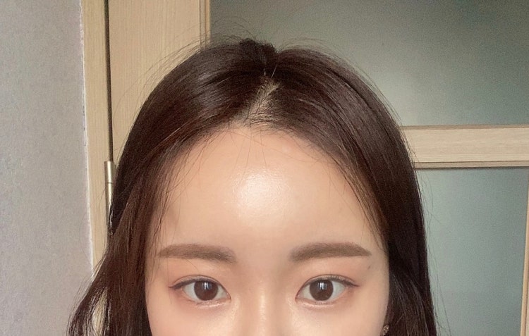 이마필러 후 붓기 (심각) 제발 도와주세요 : 지식iN 이마필러 후 붓기 (심각) 제발 도와주세요 : 지식In