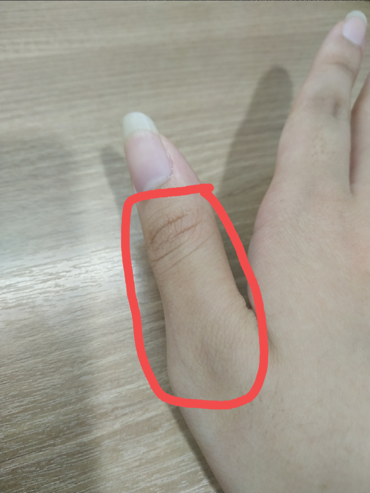 엄지손가락이 아파요 : 지식In