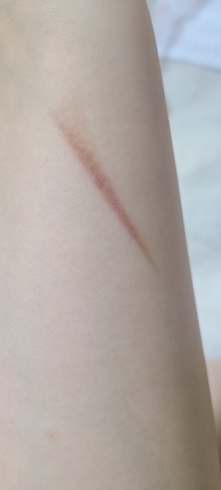 화상 흉터 및 색소침착 : 지식iN 화상 흉터 및 색소침착 : 지식In