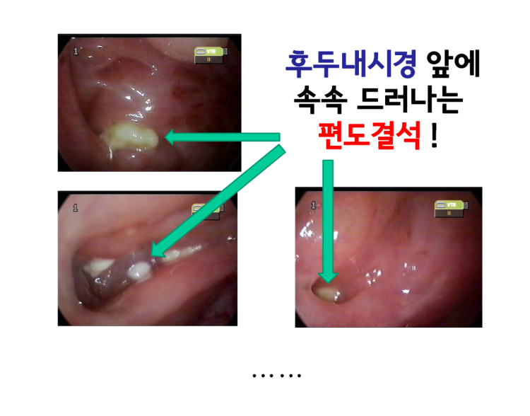 편도결석 예방? 수술? : 지식iN 편도결석 예방? 수술? : 지식In