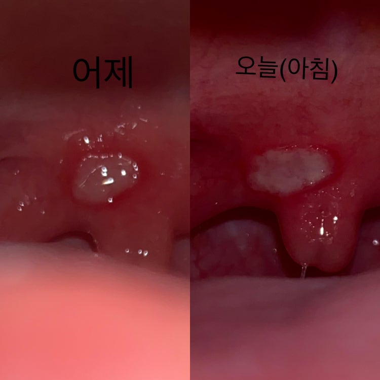 목젖 염증,구내염(?) : 지식iN 목젖 염증,구내염(?) : 지식In