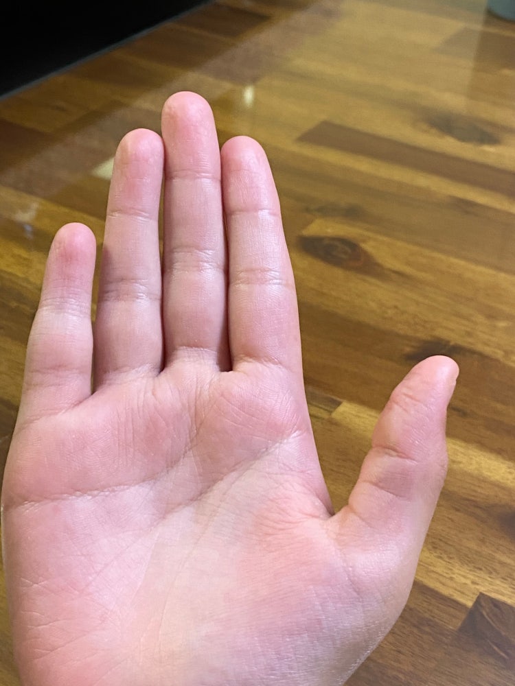 저 새끼손가락 단지증인가욤 : 지식In