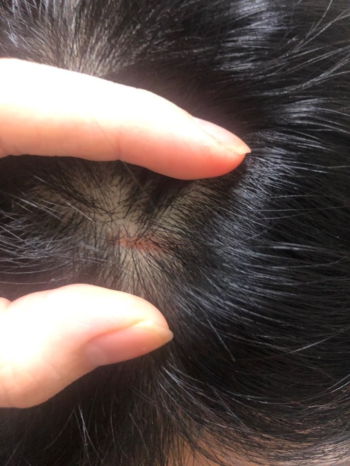 머리에서 좀 피가나고 따끔거려요ㅜ : 지식In