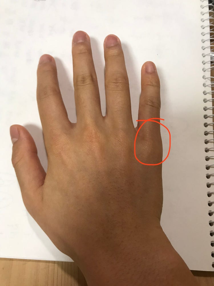 새끼손가락 통증 : 지식iN 새끼손가락 통증 : 지식In