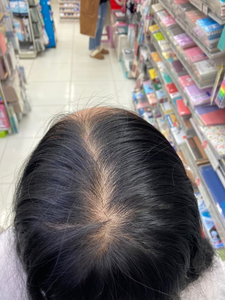 청소년 여자 탈모 : 지식iN 청소년 여자 탈모 : 지식In