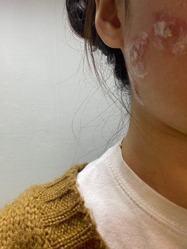 점빼고 듀오덤 접촉성 피부염 : 지식iN 점빼고 듀오덤 접촉성 피부염 : 지식In