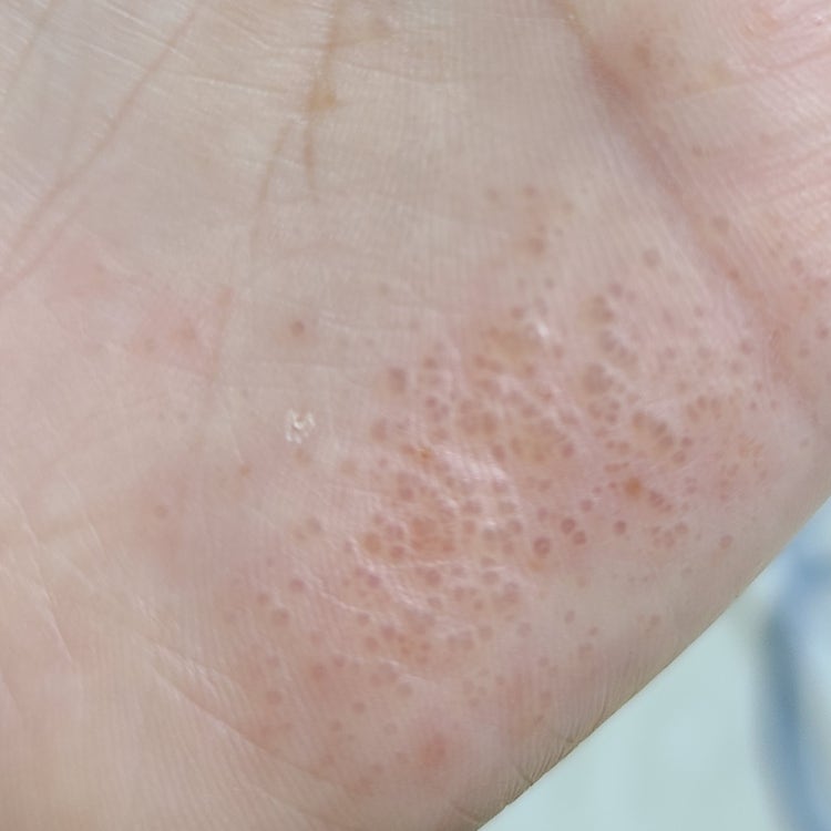 손에 물집 생겼는데 이게 뭔가요? : 지식iN