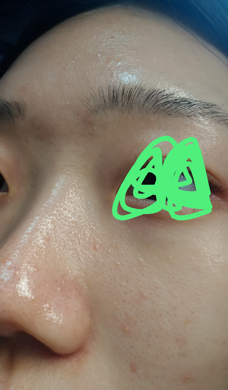 이 피부질환이 요철 맞나요? : 지식iN