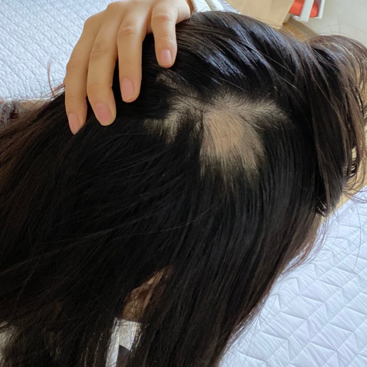 여자 원형탈모 봐주세요ㅠㅠ : 지식iN 여자 원형탈모 봐주세요ㅠㅠ : 지식In