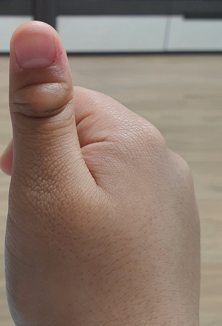 엄지손가락 굳은살 : 지식iN 엄지손가락 굳은살 : 지식In