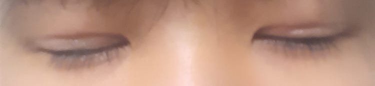 남자 속쌍 눈매교정 흉터 : 지식iN