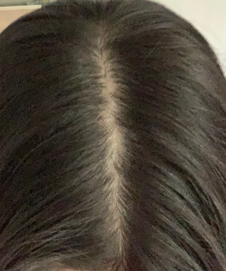 여자 가르마 탈모 : 지식iN 여자 가르마 탈모 : 지식In