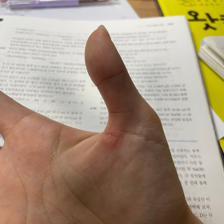 엄지 손가락 굳은살 : 지식iN 엄지 손가락 굳은살 : 지식In