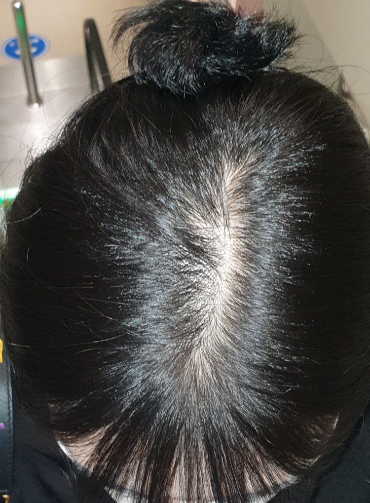 여자 탈모 여부 판단 부탁드려요 : 지식iN 여자 탈모 여부 판단 부탁드려요 : 지식In