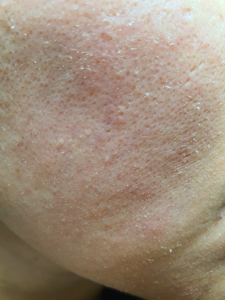 피부건조?각질 : 지식iN