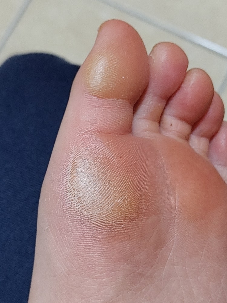 왼쪽 검지 발바닥 굳은 살 : 지식iN 왼쪽 검지 발바닥 굳은 살 : 지식In
