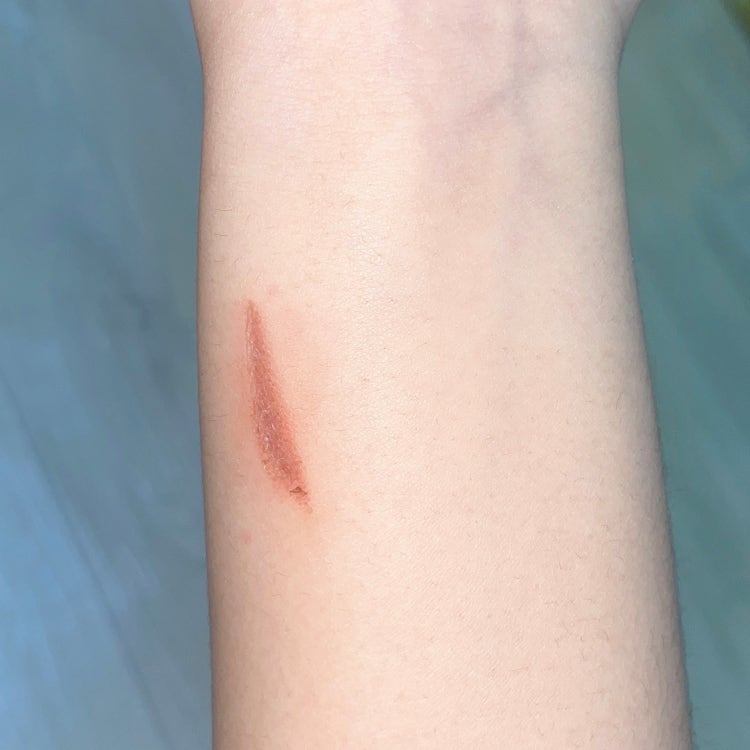 화상 흉터 (사진 첨부) : 지식iN 화상 흉터 (사진 첨부) : 지식In