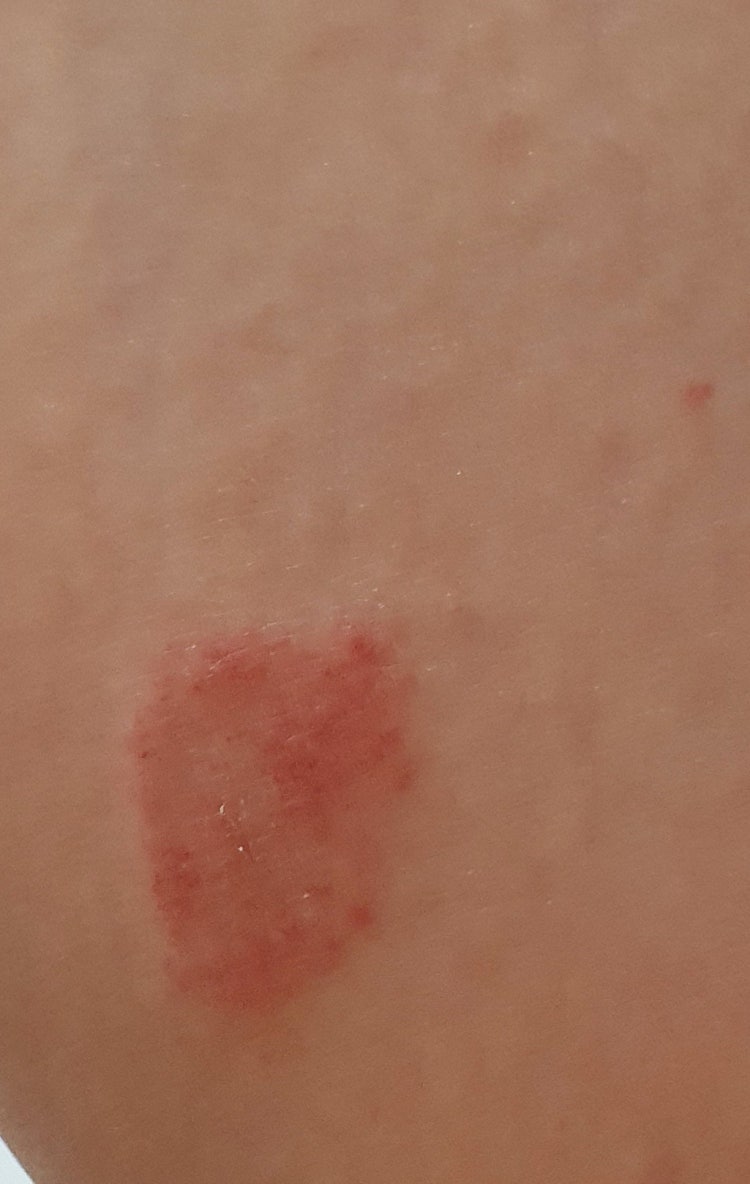 발진? 붉은 점..? 아토피...? : 지식iN