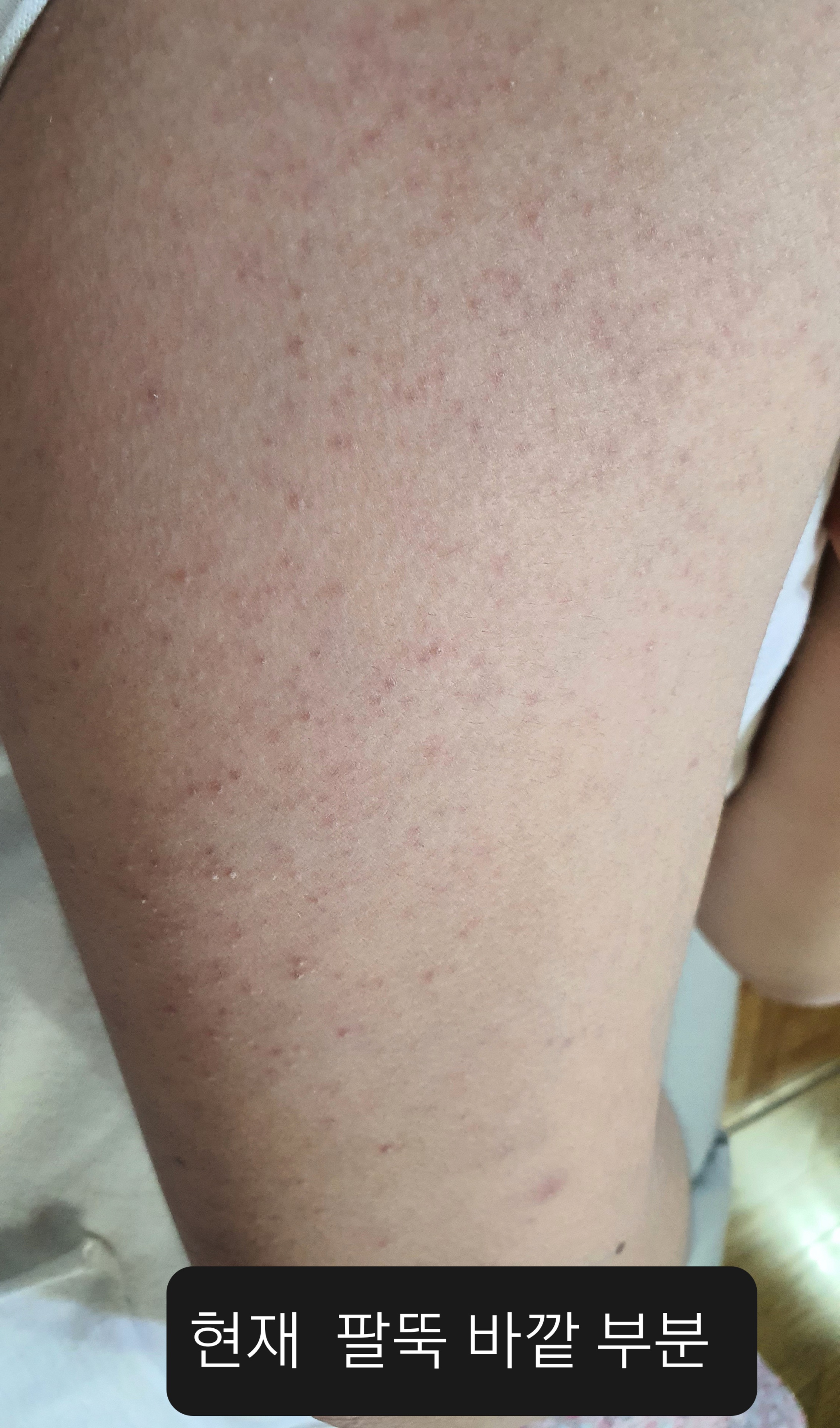 도와주세요~!! (사진첨부)단순 아토피일까요,피부질환인가요? : 네이버 지식iN