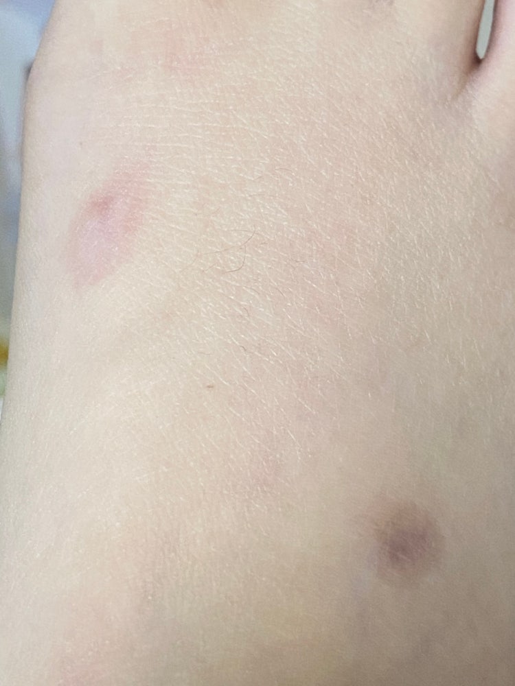 발등 화상 흉터 제거 : 지식iN 발등 화상 흉터 제거 : 지식In