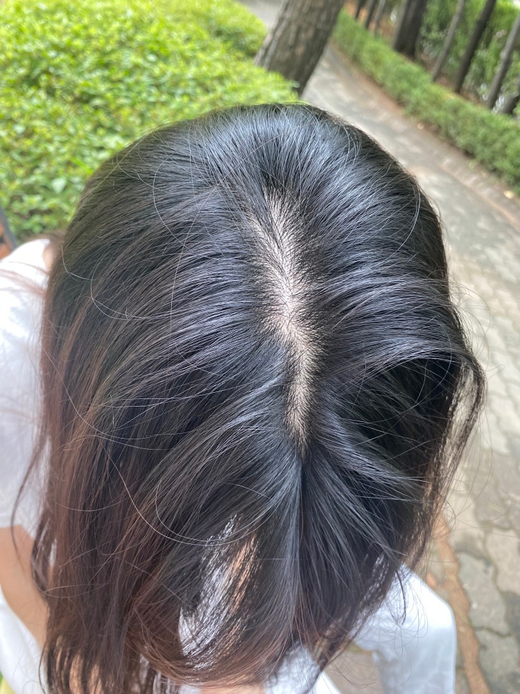 20대 여자 탈모 진행중인가요? : 지식iN 20대 여자 탈모 진행중인가요? : 지식In