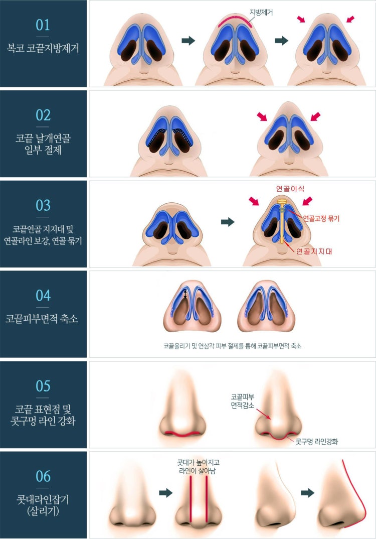 뚱뚱한 복코 수술 방법 : 지식In