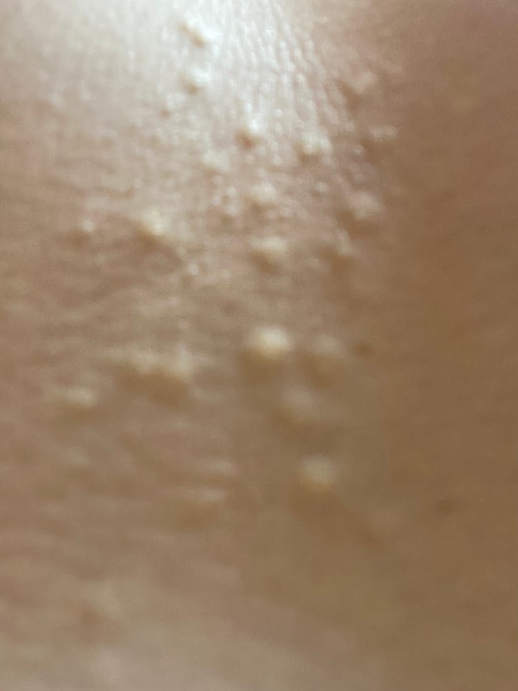 피부병 종류 : 지식In