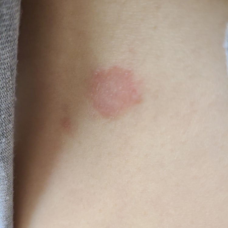 피부 발진, 가려움증 증상이 있어요 : 지식iN