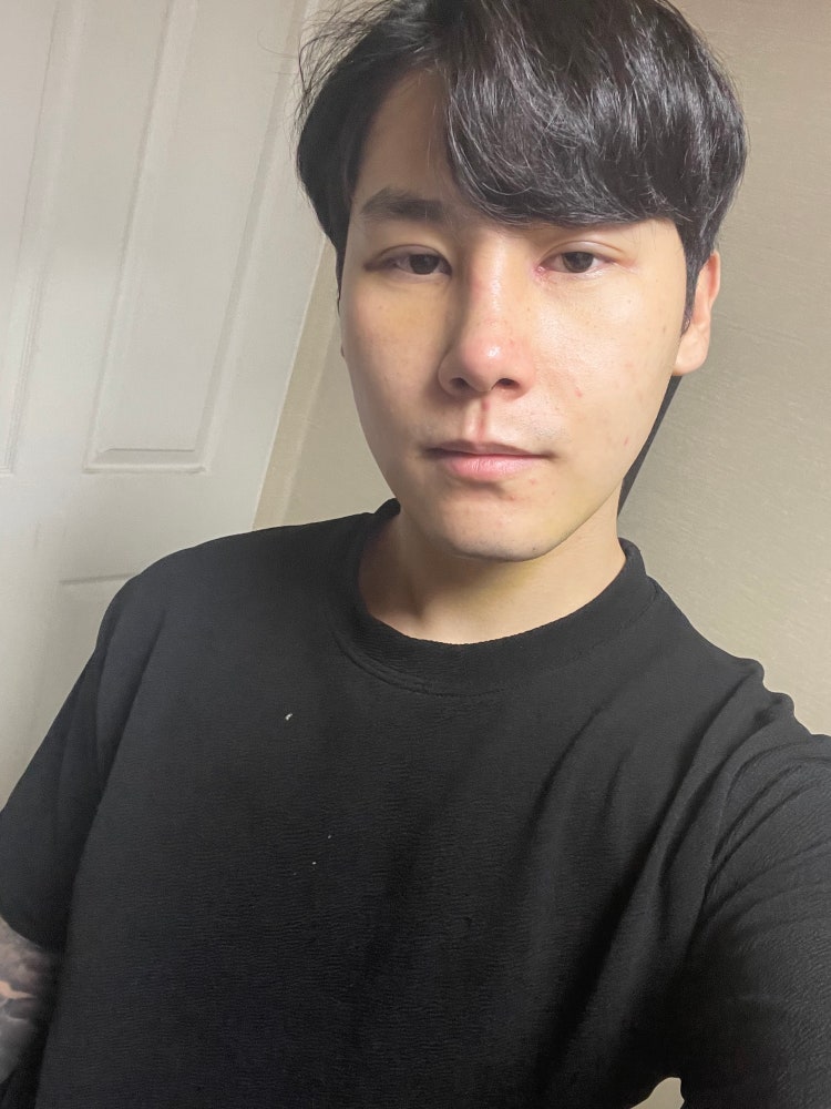 [나눈질문2] 속쌍 절대눈매교정 앞트임 코수술후 붓기 : 지식iN