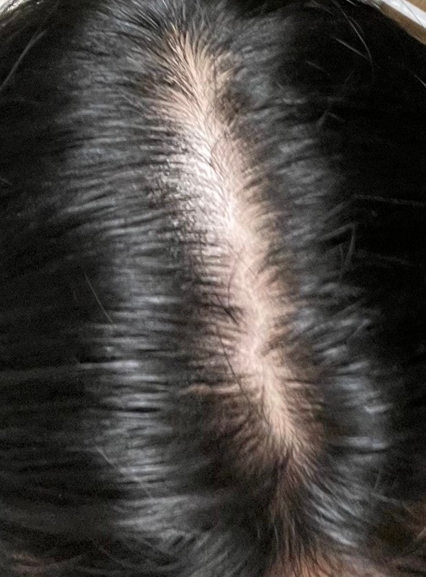 20대 여자 탈모 미녹시딜 : 지식iN 20대 여자 탈모 미녹시딜 : 지식In