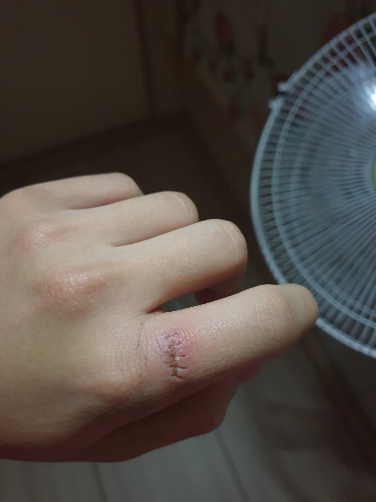 손가락 봉합수술하고 스스로 실밥을 풀었는데요... : 지식In