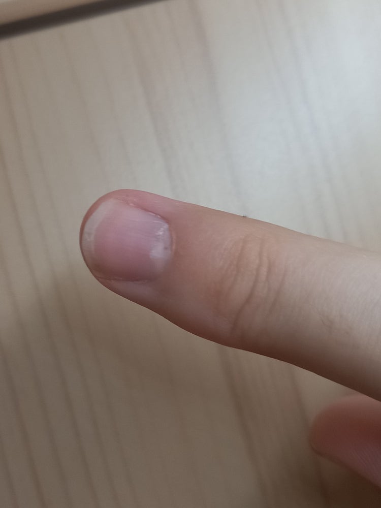 손가락 중지 굳은살 없애는법 : 지식iN 손가락 중지 굳은살 없애는법 : 지식In