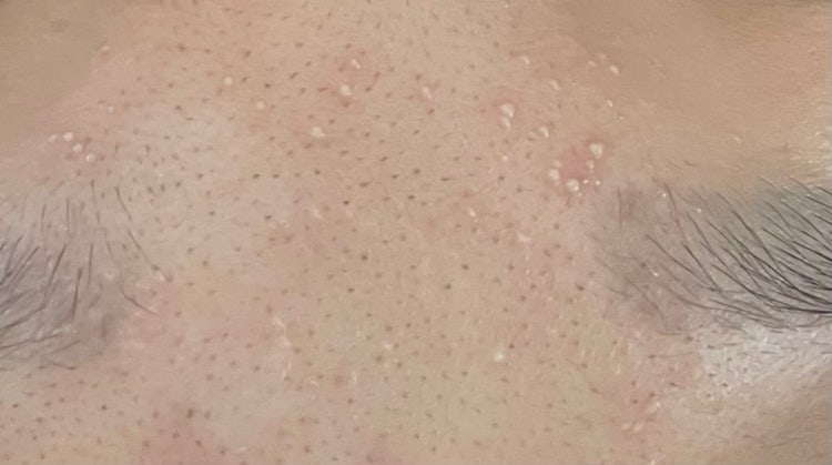 피부 전체에 수포? 여드름? 같은게 났어요 : 지식iN