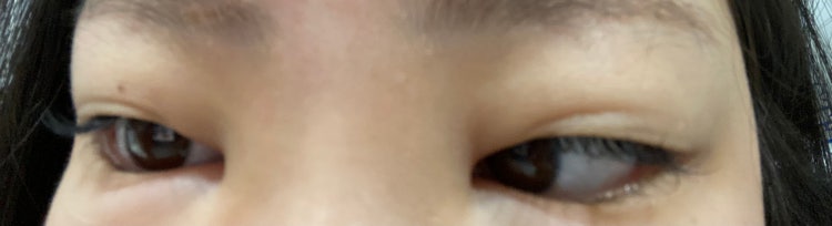 이마필러 붓기 급해요.. : 지식iN 이마필러 붓기 급해요.. : 지식In