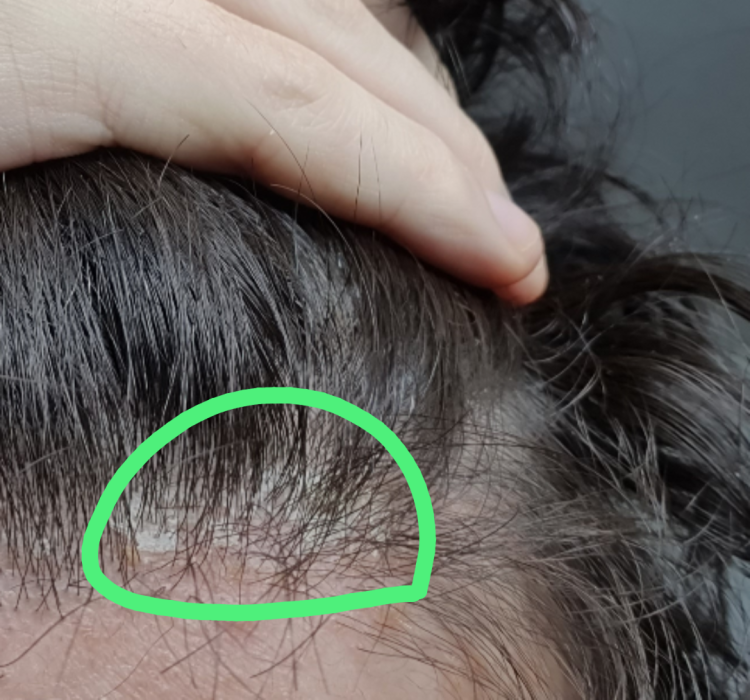 두피에 하얀각질 : 지식iN
