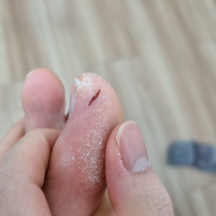 발가락 굳은살 갈라짐 연고 추천해주세요! : 지식iN 발가락 굳은살 갈라짐 연고 추천해주세요! : 지식In