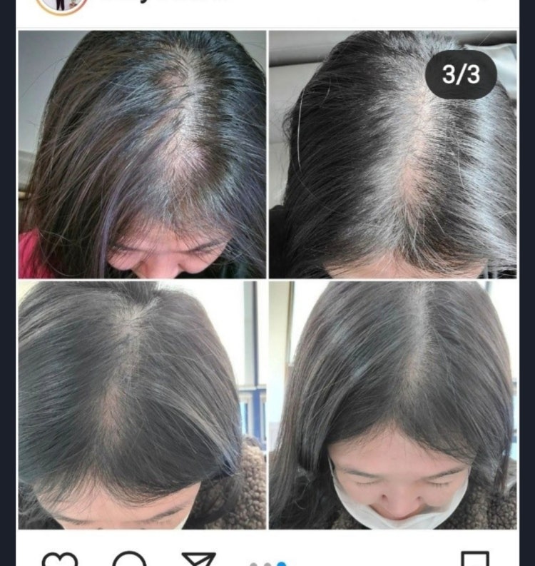 여자 20대 탈모 : 지식In