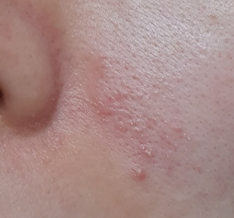 *사진주의*피부염증?알러지?수포?인가요 피부병인가요 : 지식iN