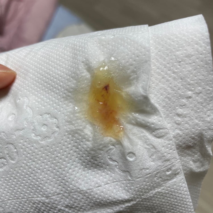가래 색 의심할 수 있는 질환 (사진첨부) : 지식iN