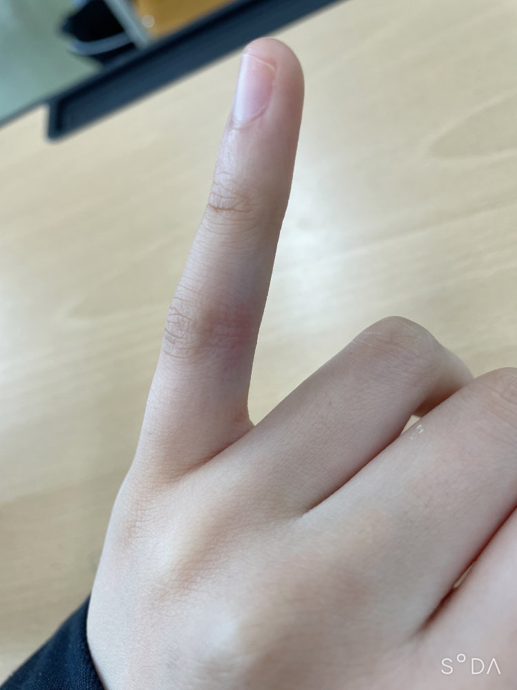 새끼손가락 통증 : 지식iN 새끼손가락 통증 : 지식In