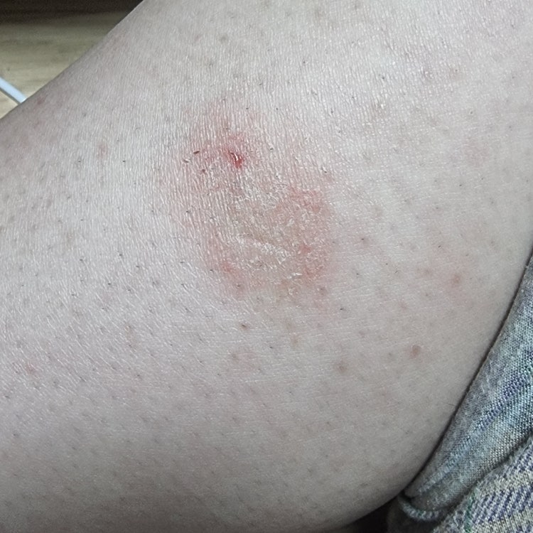 피부 습진?인가요 : 지식iN